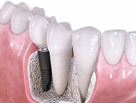 种植牙如何进行维护