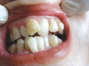 牙齿不齐的原因都有哪些