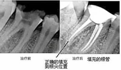 根管治疗案例3